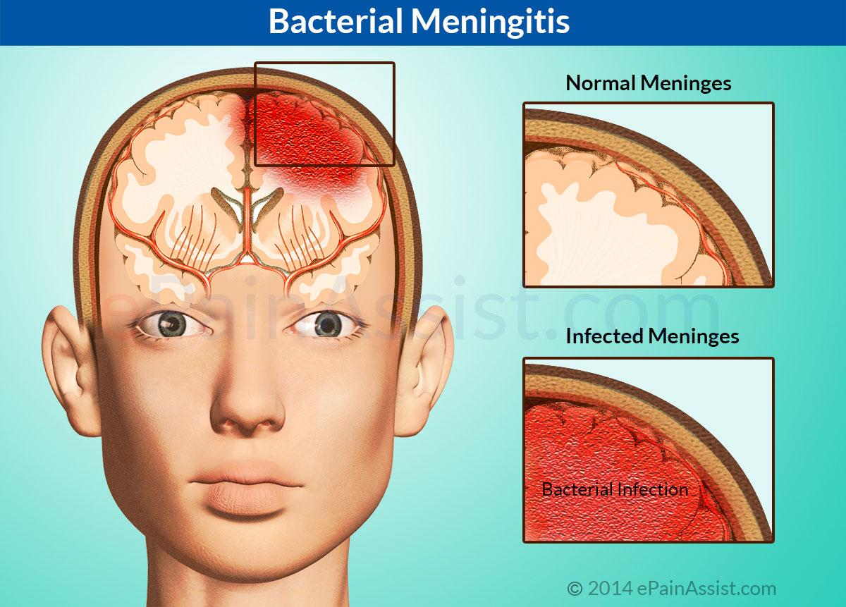 Meningite A Inflama O Das Meninges Meningitis Bacterial Hot Sex Picture 8451